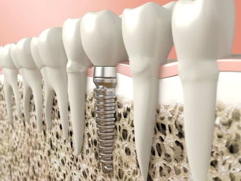 Dental Implants or Dentures: Choosing Your Ideal Smile