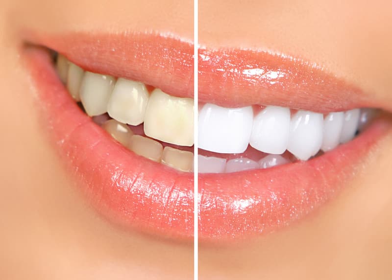 In-Office vs At-Home Teeth Whitening Guide