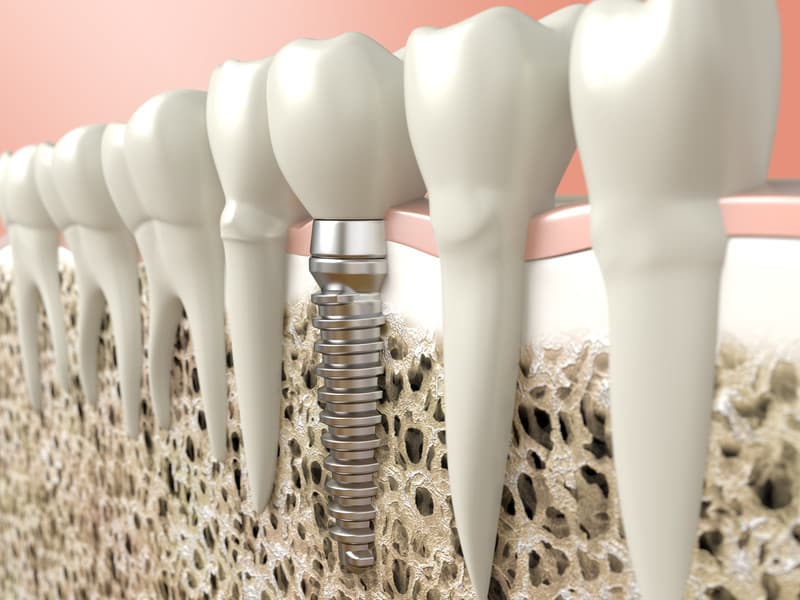 Rediscover Culinary Delights with Dental Implants