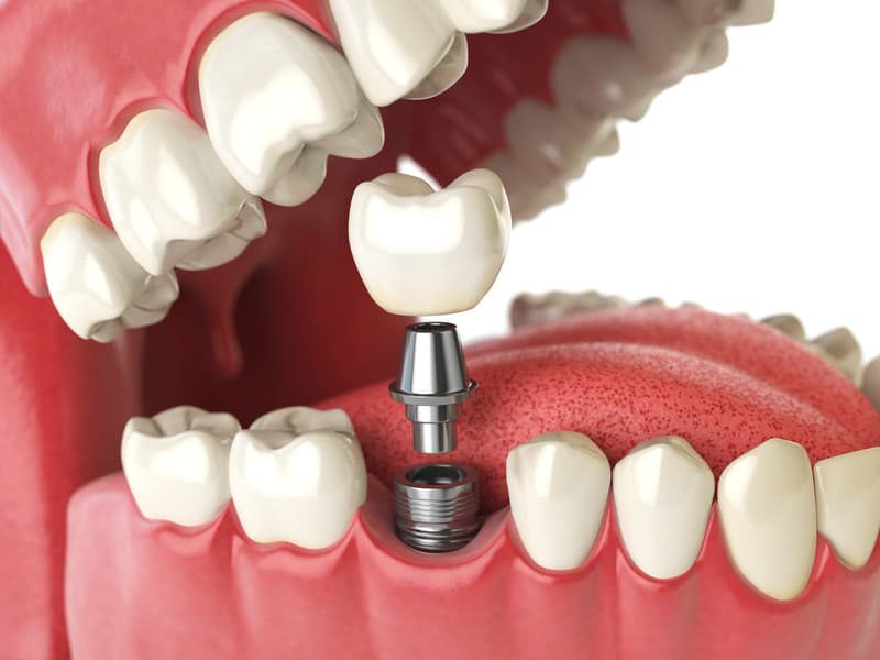 Navigating Dental Implant Options: Your Guide to Choices