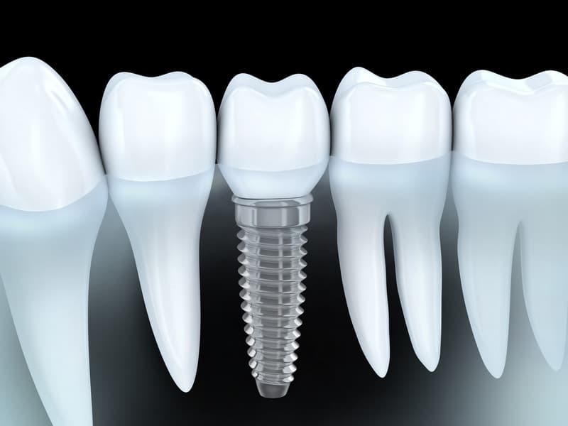 Dental Implants: The Cavity-Resistant Smile Solution