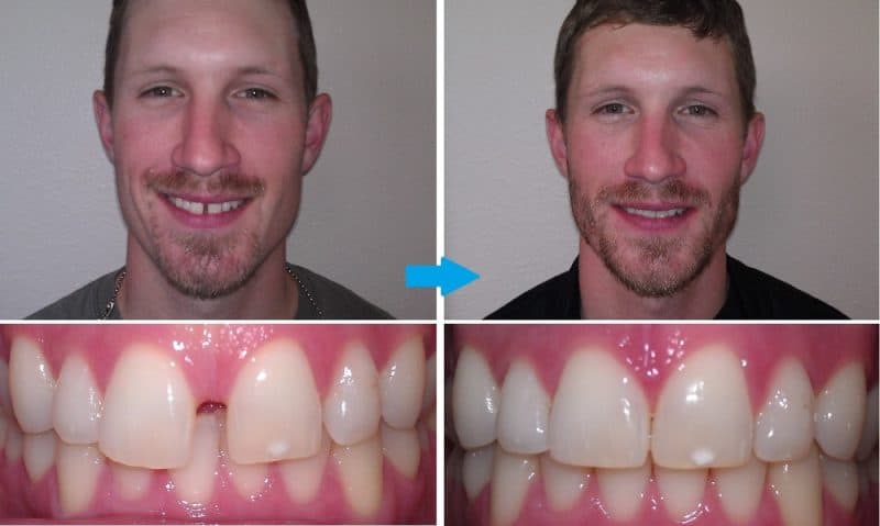Before and after photos of braces fixing a tooth gap