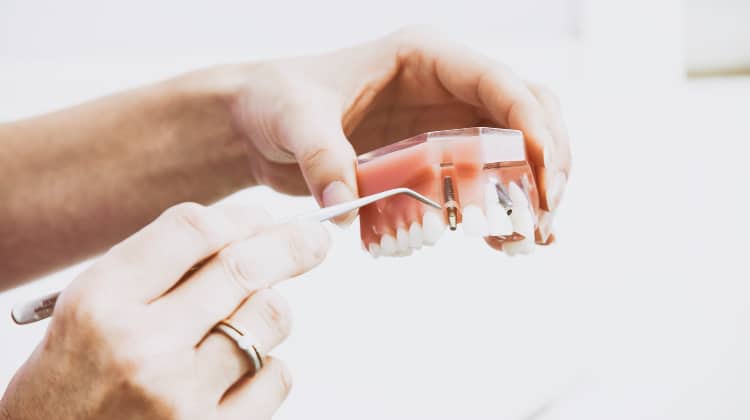 Closeup of the hands of a dentist explaining how dental implants work on a plastic tooth model