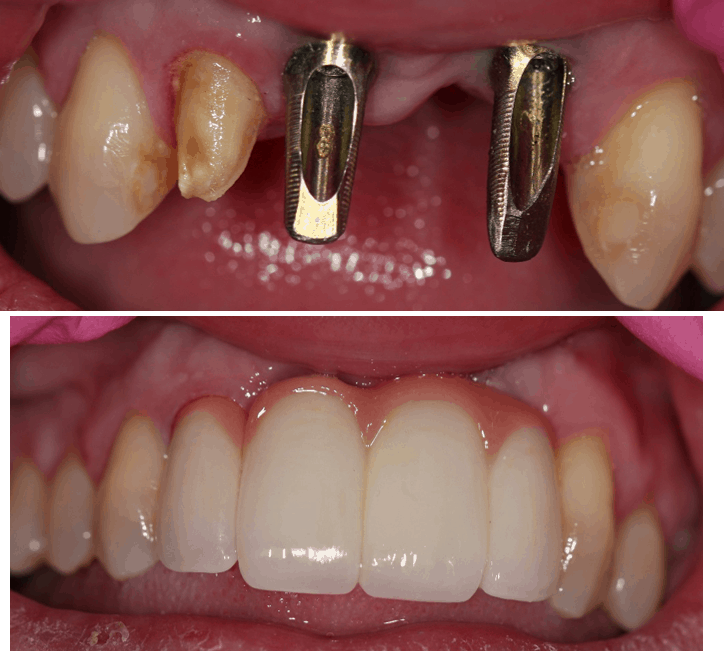 Dental Implant and Implant Bridge