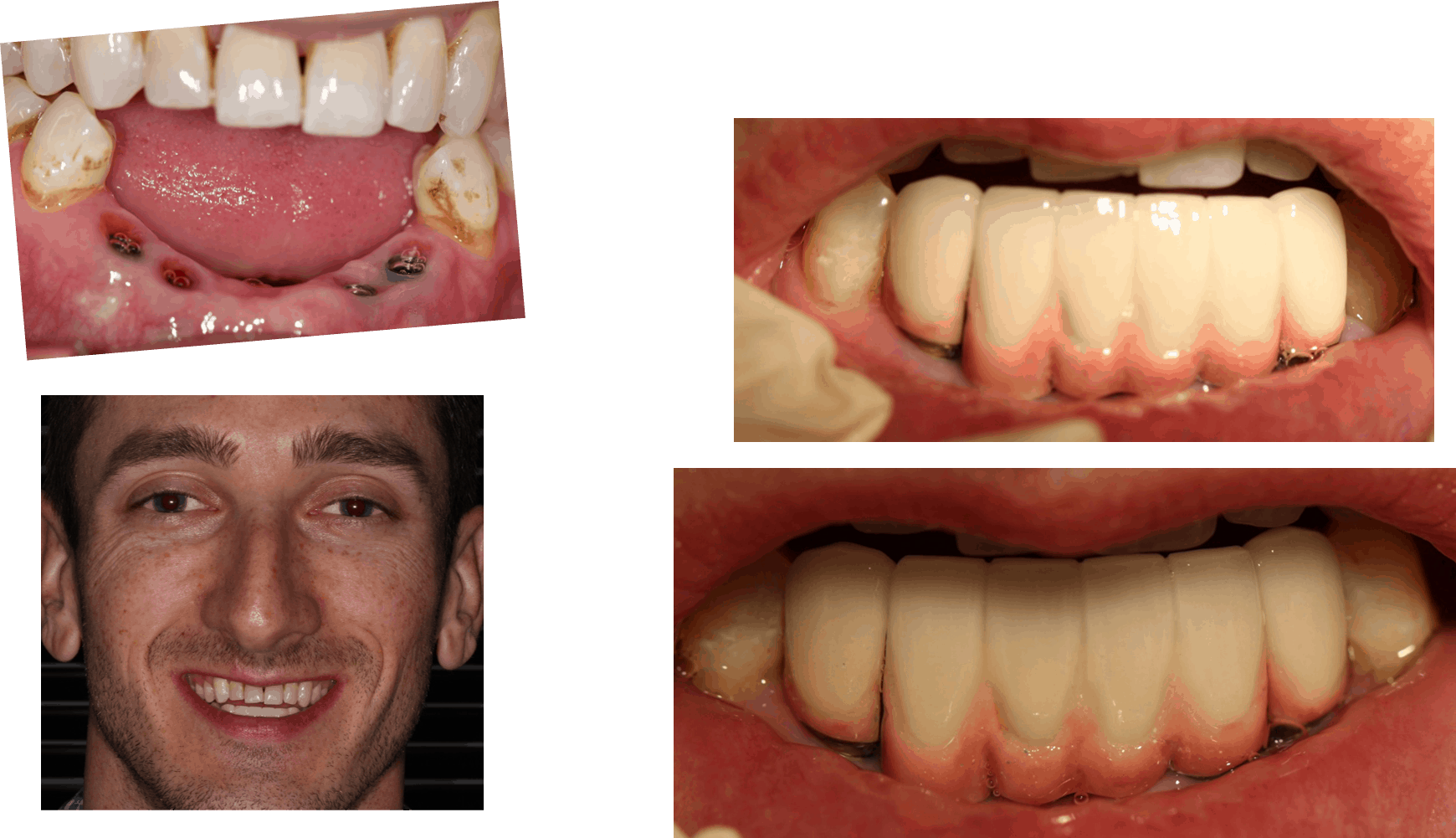 Dental Implants and Implant Bridge