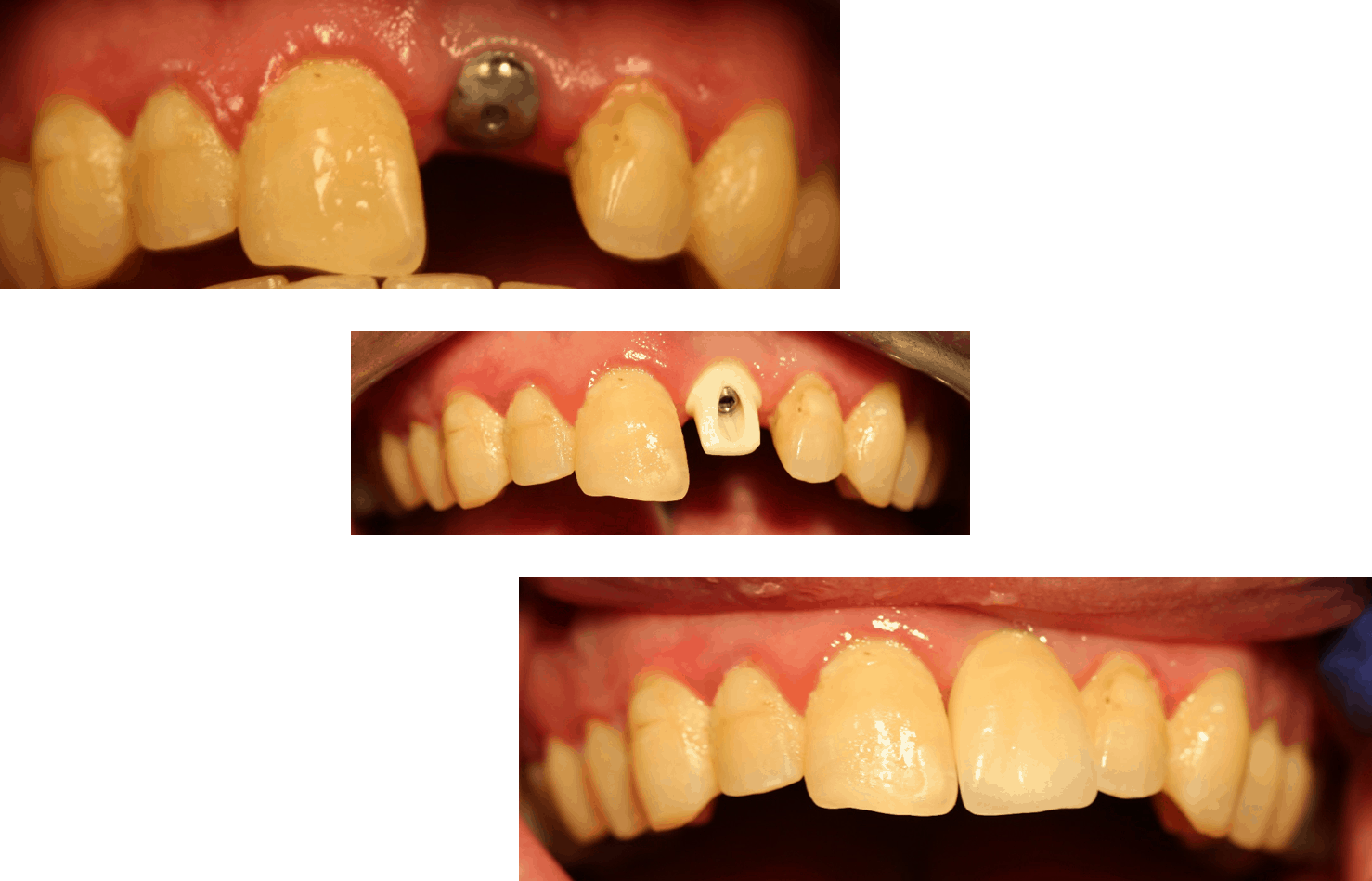 Dental Implant and Implant Crown