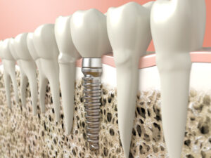 Rediscover Culinary Delights with Dental Implants