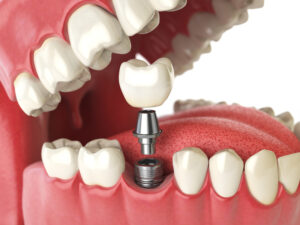 Navigating Dental Implant Options: Your Guide to Choices