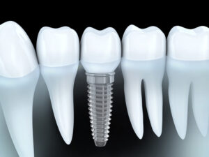 Dental Implants: The Cavity-Resistant Smile Solution