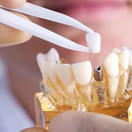 Dental Implants Phoenix